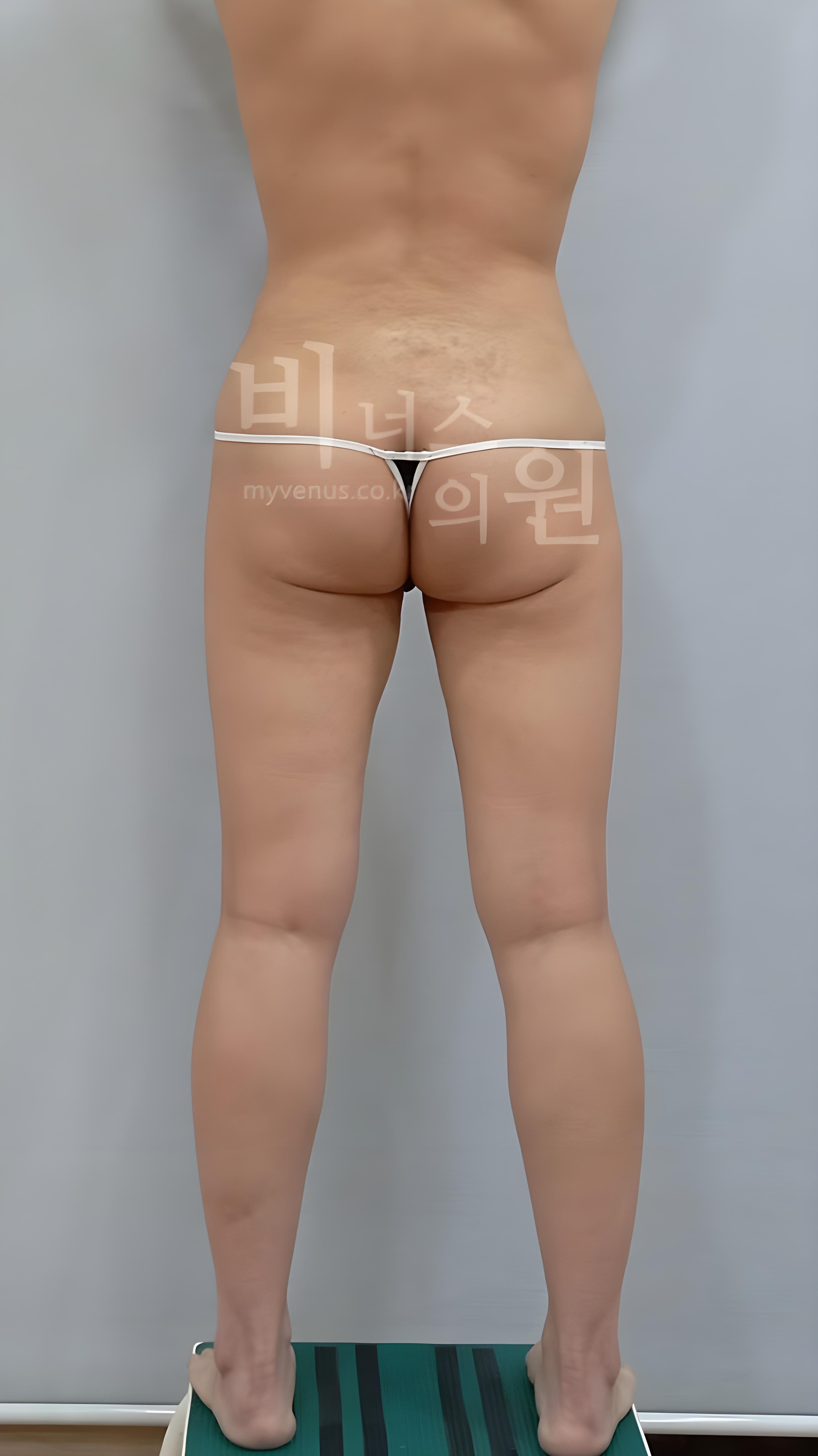 엉덩이 지방흡입 수술 전 후면 비너스의원