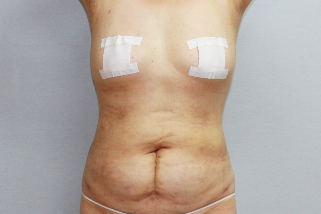 대용량복부지방흡입 복부지방흡입 옆구리지방흡입 미니지방흡입 아랫배지방흡입 윗배지방흡입 러브핸들지방흡입 전측복부지방흡입 뱃살지방흡입 뱃살빼기 복부지방흡입효과 복부지방흡입경과 복부지방흡입후기 복부지방흡입부작용 복부지방흡입울퉁불퉁 복부지방흡입 멍 부기 복부지방흡입고주파 (2).jpg