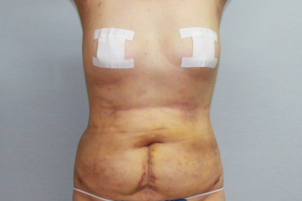 대용량복부지방흡입 복부지방흡입 옆구리지방흡입 미니지방흡입 아랫배지방흡입 윗배지방흡입 러브핸들지방흡입 전측복부지방흡입 뱃살지방흡입 뱃살빼기 복부지방흡입효과 복부지방흡입경과 복부지방흡입후기 복부지방흡입부작용 복부지방흡입울퉁불퉁 복부지방흡입 멍 부기 복부지방흡입고주파 (3).JPG