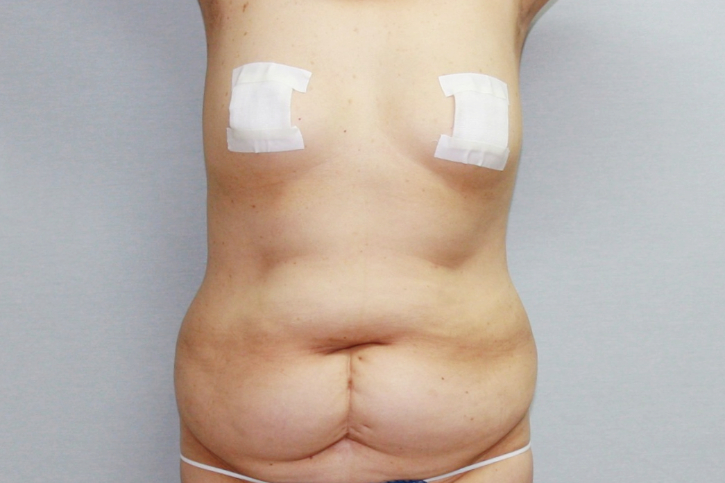 대용량복부지방흡입 복부지방흡입 옆구리지방흡입 미니지방흡입 아랫배지방흡입 윗배지방흡입 러브핸들지방흡입 전측복부지방흡입 뱃살지방흡입 뱃살빼기 복부지방흡입효과 복부지방흡입경과 복부지방흡입후기 복부지방흡입부작용 복부지방흡입울퉁불퉁 복부지방흡입 멍 부기 복부지방흡입고주파.jpg