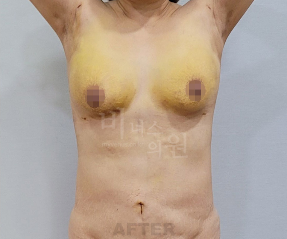 유방처짐 표층 지방흡입 수술 후 정면(팔을 올린 자세) 비너스의원