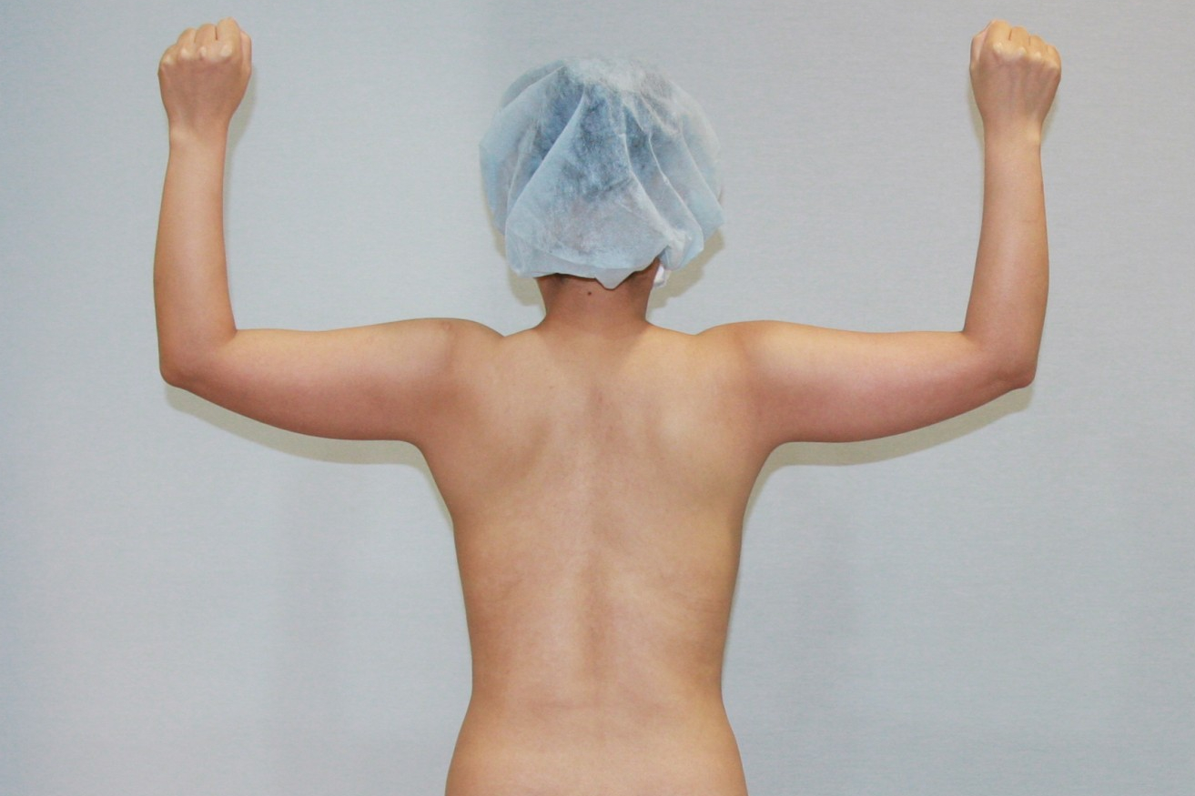 팔뚝살빼기 팔뚝살지방흡입 팔지방흡입 대용량팔뚝지방흡입 미니팔뚝지방흡입 처진팔뚝살 팔뚝지방흡입후관리 후기 경과 1-4주 멍 부기 압박복 마사지 관리 팔뚝지방흡입부작용.jpg