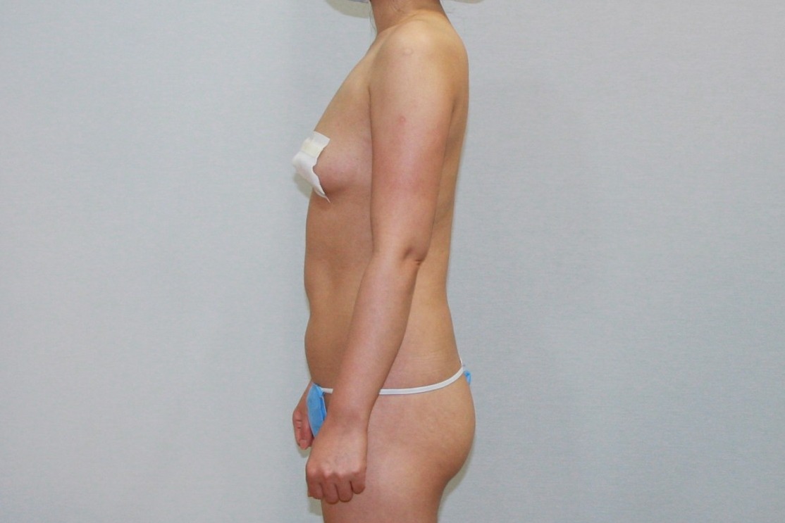 팔뚝살빼기 팔뚝살지방흡입 팔지방흡입 대용량팔뚝지방흡입 미니팔뚝지방흡입 처진팔뚝살 팔뚝지방흡입후관리 후기 경과 4주 멍 부기.JPG