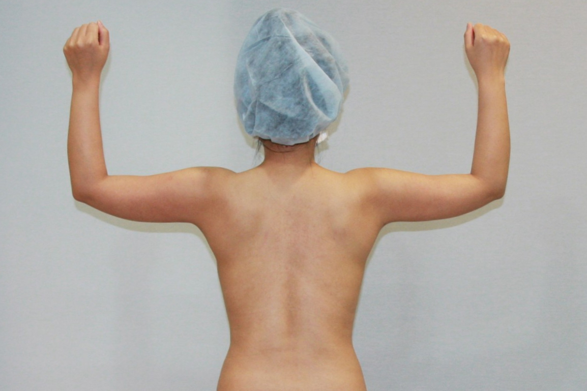 팔뚝살빼기 팔뚝살지방흡입 팔지방흡입 대용량팔뚝지방흡입 미니팔뚝지방흡입 처진팔뚝살 팔뚝지방흡입후관리 후기 경과 1-4주 멍 부기 마사지 관리팔뚝압박복.jpg