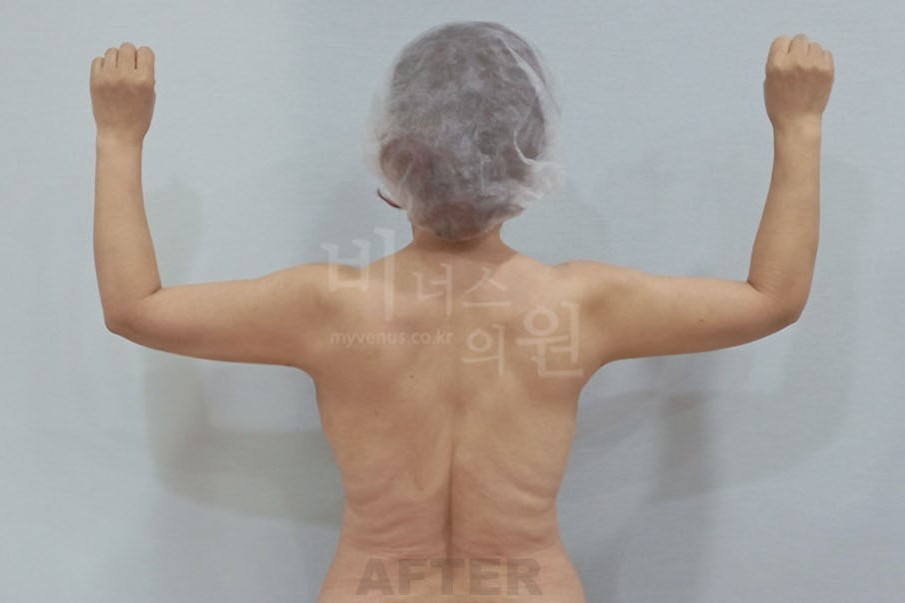 팔뚝살지방흡입_2.jpg