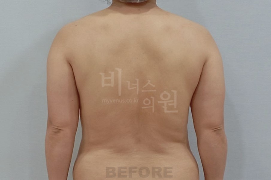 팔지방흡입_2 (2).JPG