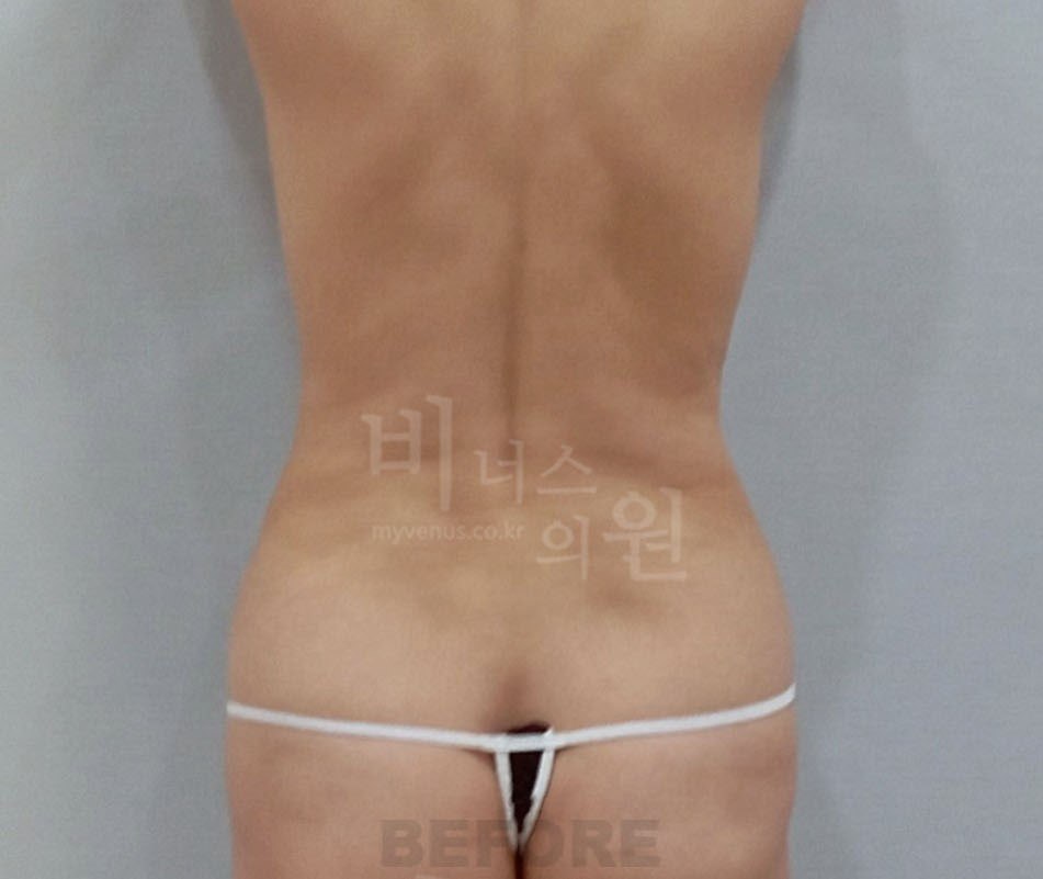 흉복부 지방흡입 전 후면