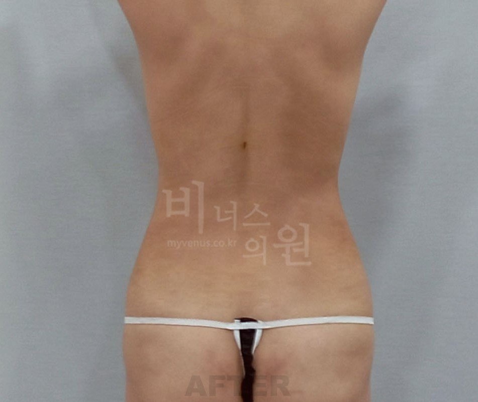 흉복부 지방흡입 후 후면
