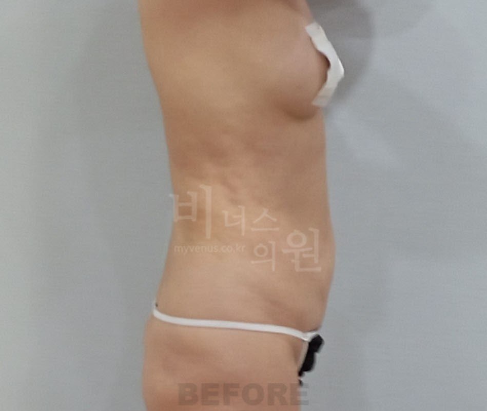 흉복부 지방흡입 전 측면2