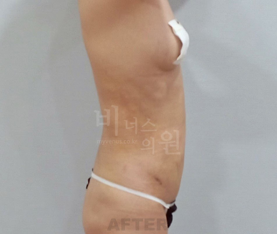 흉복부 지방흡입 후 측면2