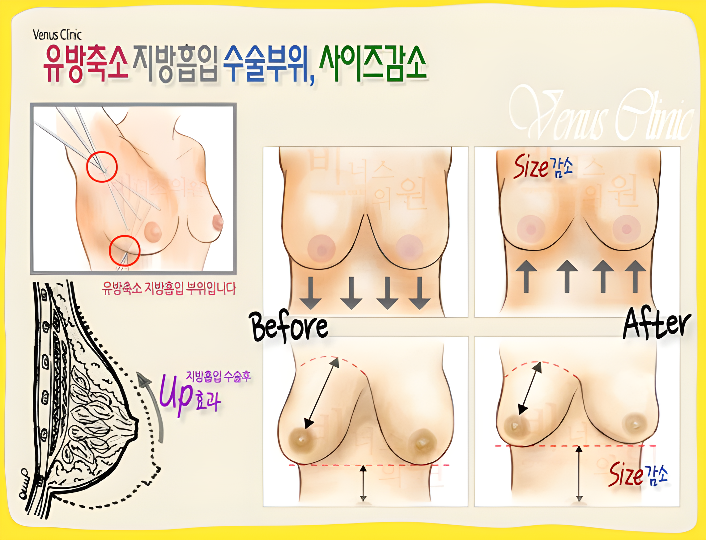 유방축소 지방흡입 수술부위와 사이즈 감소 원리를 보여주는 도식 비너스의원