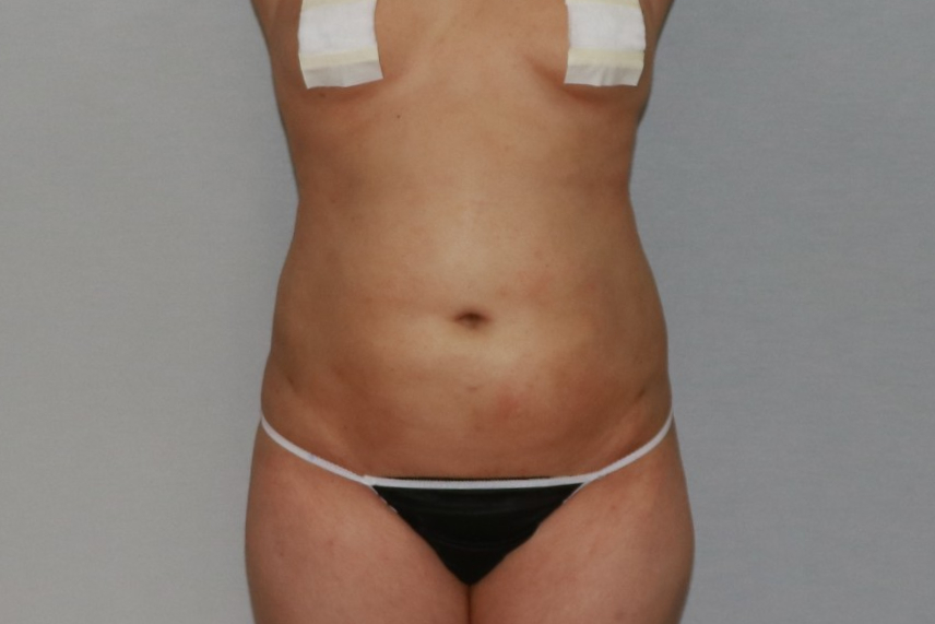 복부 뱃살 옆구리 똥배 아랫배 윗배 흉부 러브핸들 지방흡입 수술후 경과 4주 후기.jpg