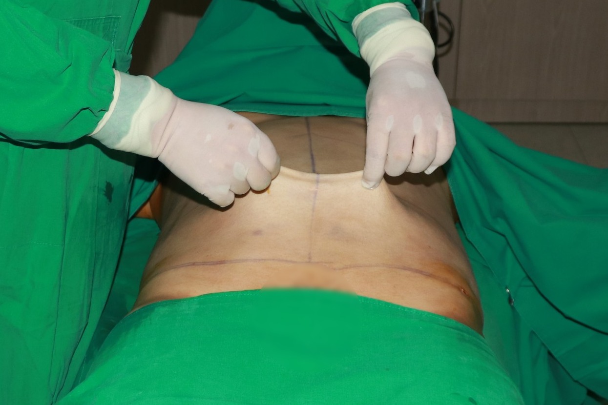 복부지방흡입 핀치테스트 복부지방흡입 경과 후기.JPG