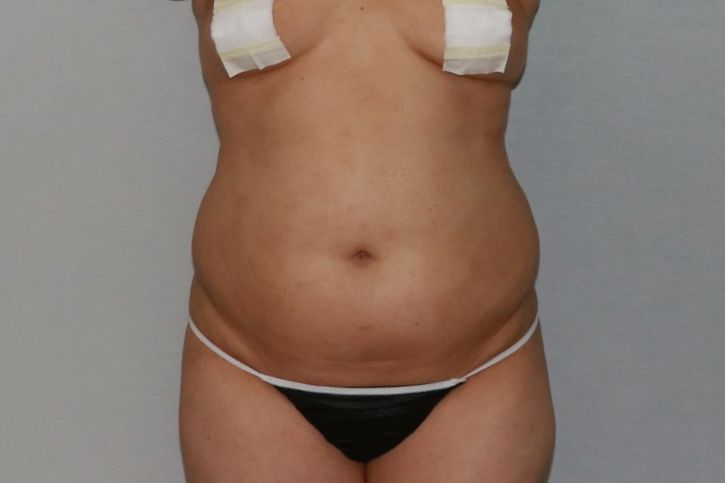 복부 뱃살 옆구리 똥배 아랫배 윗배 흉부 러브핸들 지방흡입 수술전 경과 후기.jpg