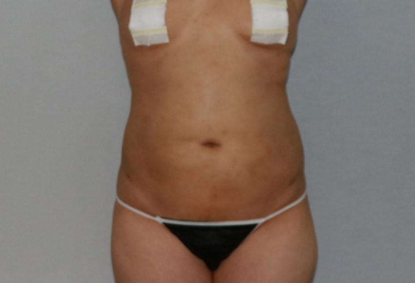 복부 뱃살 옆구리 똥배 아랫배 윗배 흉부 러브핸들 지방흡입 수술후 경과 1주 후기.jpg