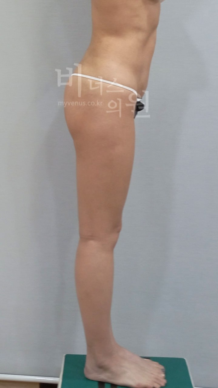 엉덩이 지방흡입 수술 후 왼측면 비너스의원