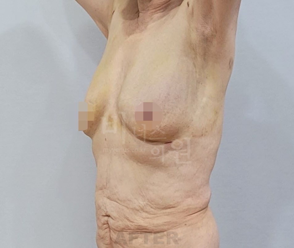 유방 지방흡입 수술 후 45도 측면 비너스의원