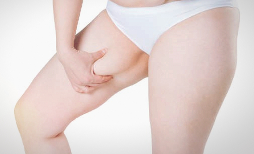 허벅지 안쪽살 지방흡입.jpg