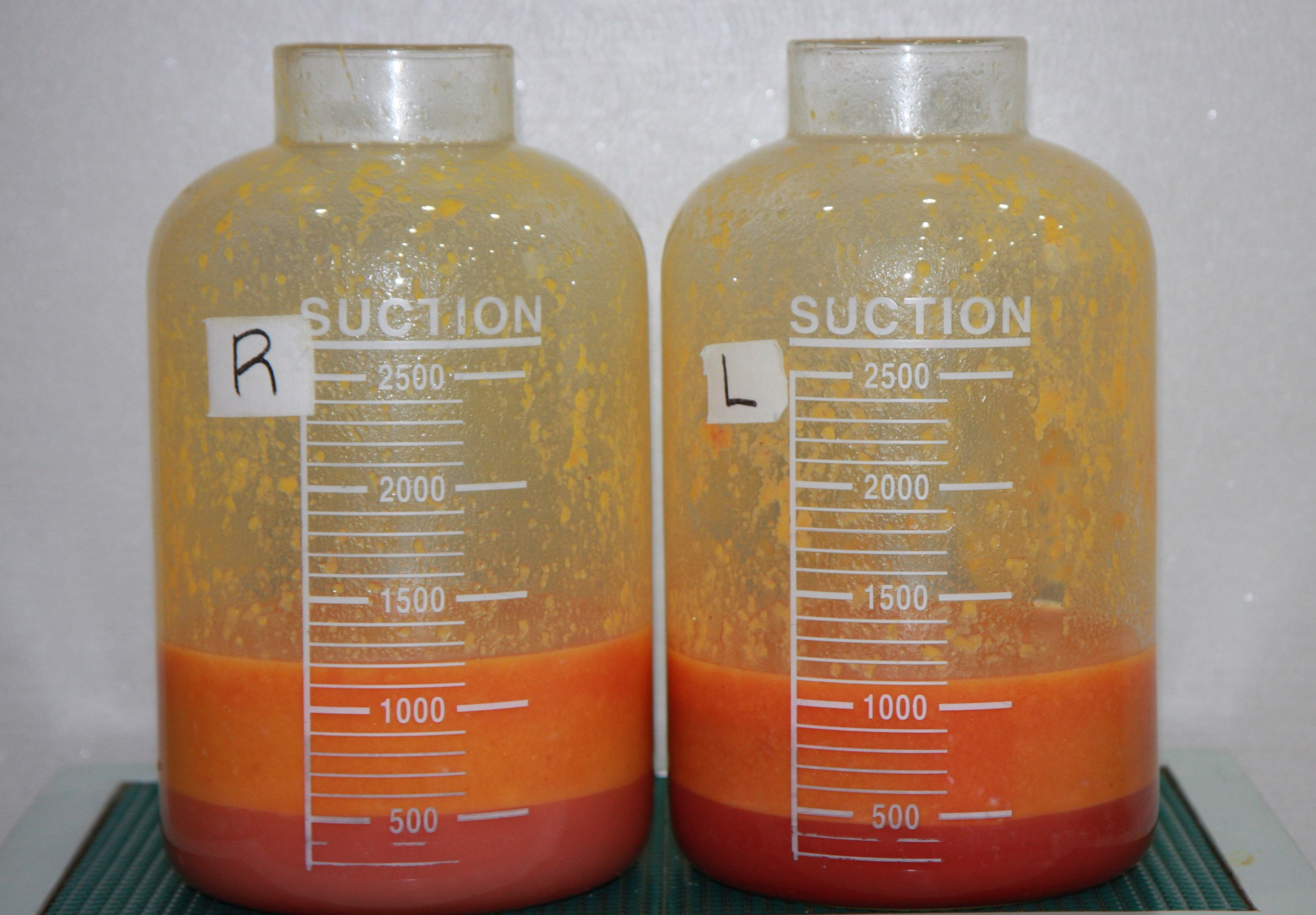 허벅지 내측 안쪽살 지방량 .jpg