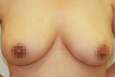 처진 유방 가슴 축소 지방흡입.JPG