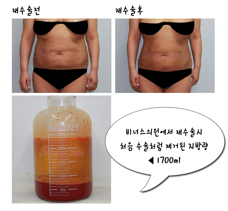 지방흡입재수술.jpg