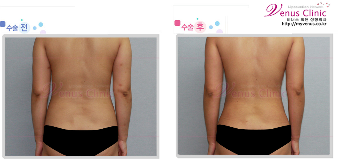지방흡입재수술1.jpg