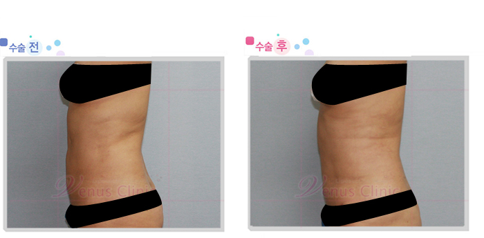 지방흡입재수술6.jpg