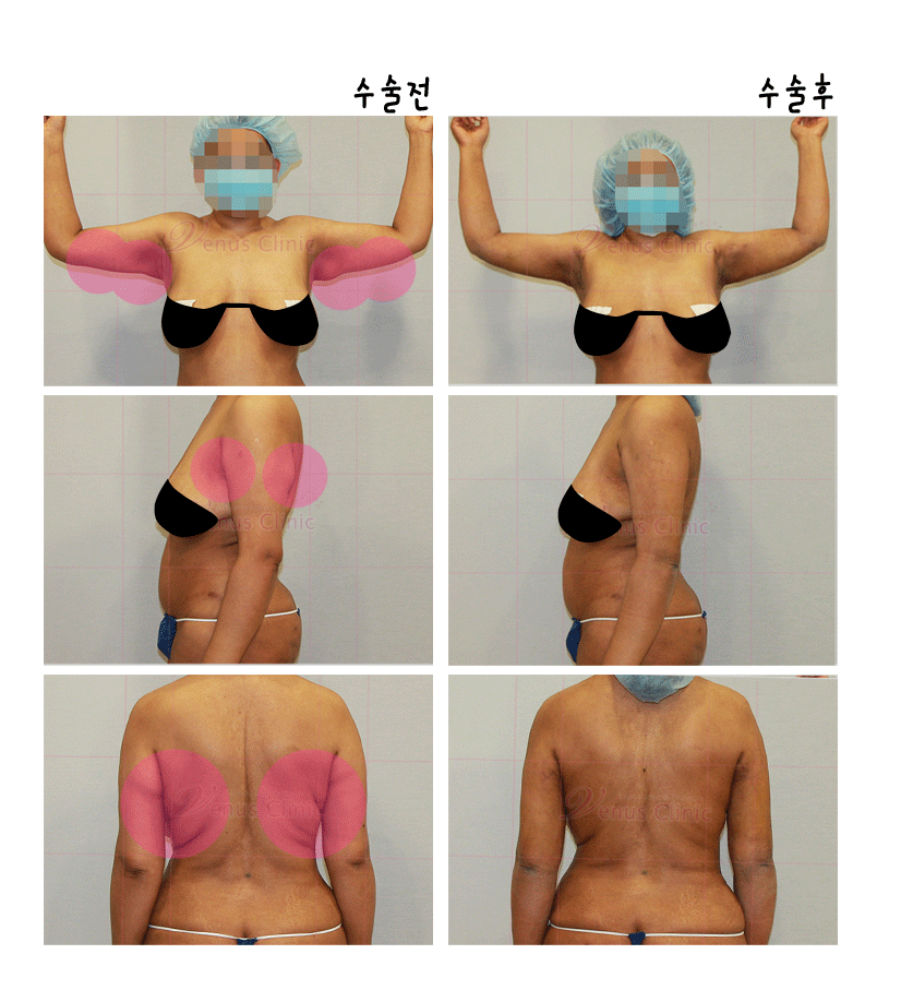 지방흡입재수술.gif