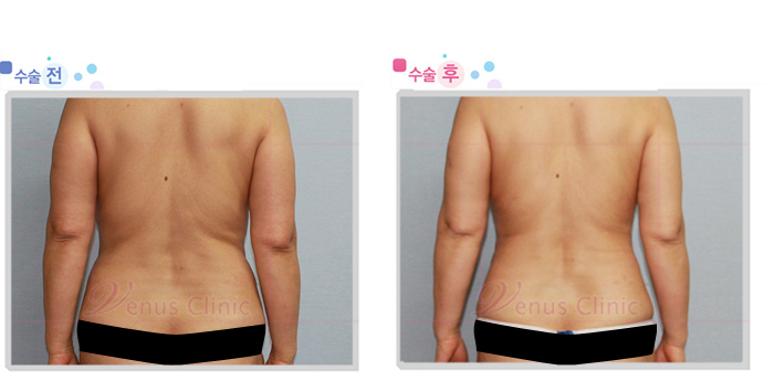 지방흡입재수술5.jpg