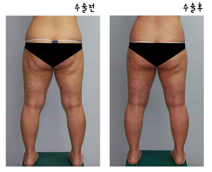 지방흡입재수술9.jpg