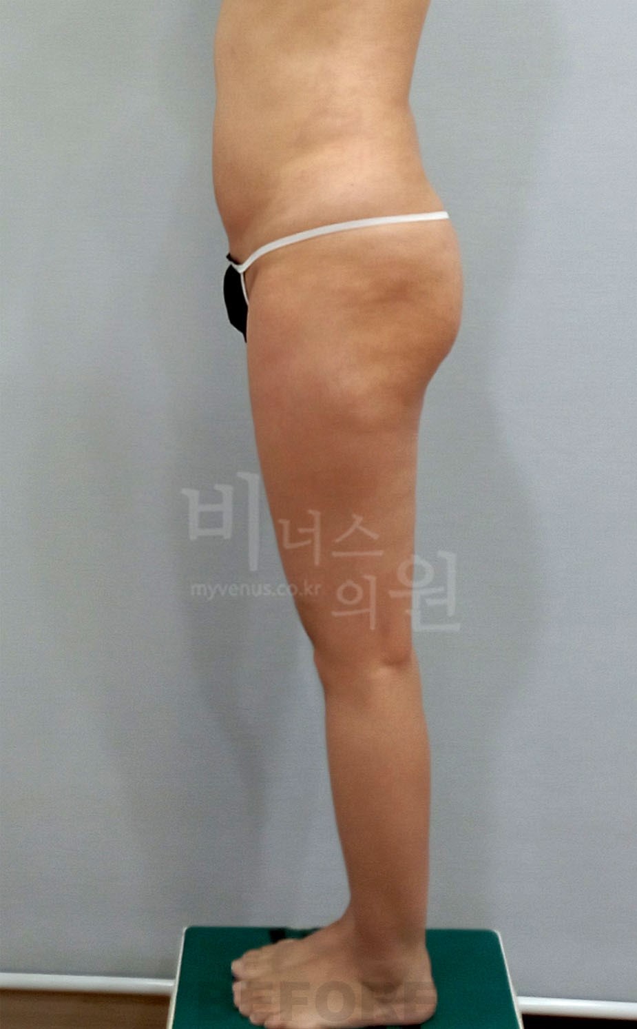 엉덩이전체·힙 지방흡입 수술 전 우측면 비너스의원