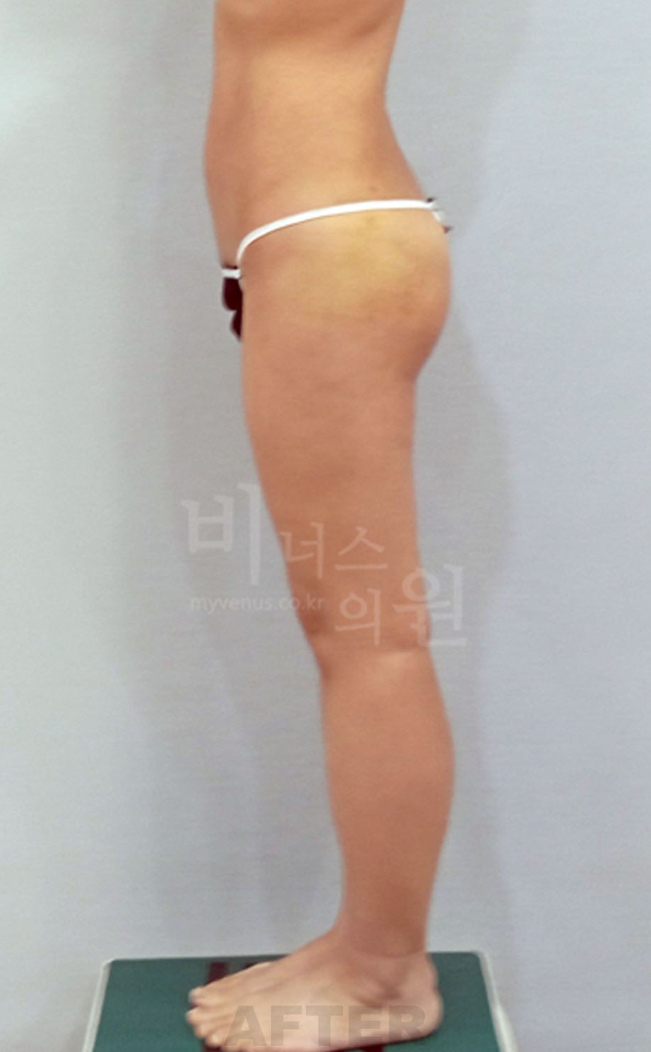엉덩이_허벅지안쪽지방흡입_1.jpg