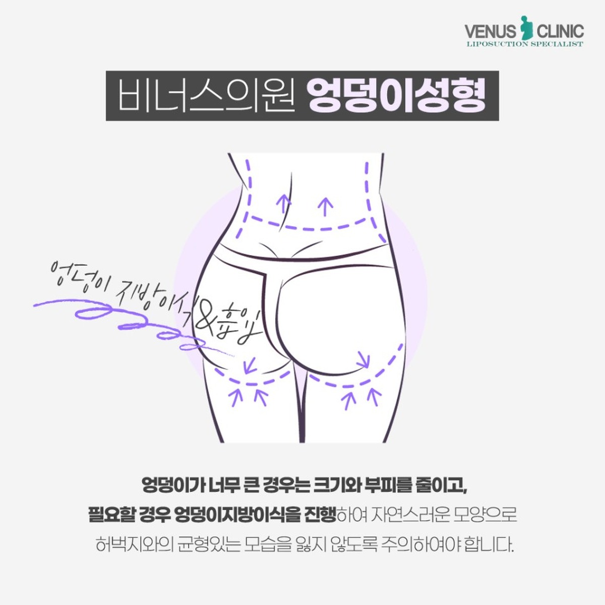 엉덩이 성형 수술 원리 이미지 — 비너스의원