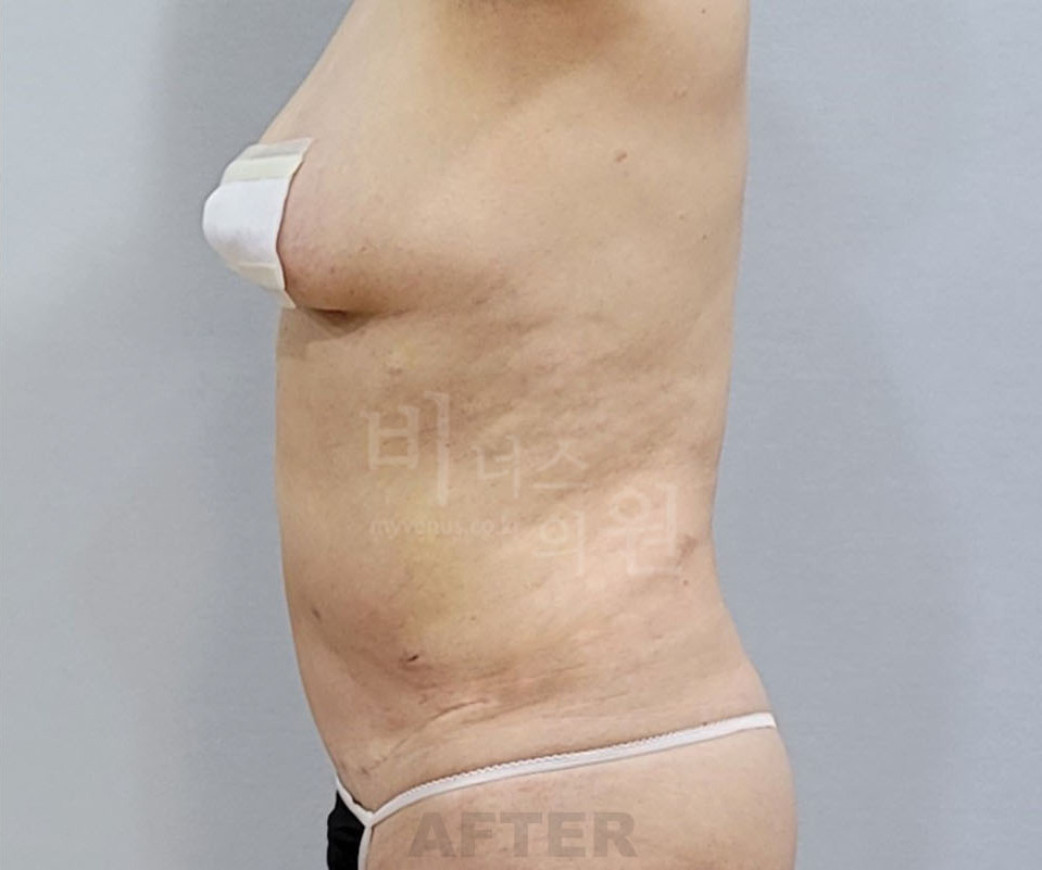 복부 지방흡입 수술 후 측면 비너스의원
