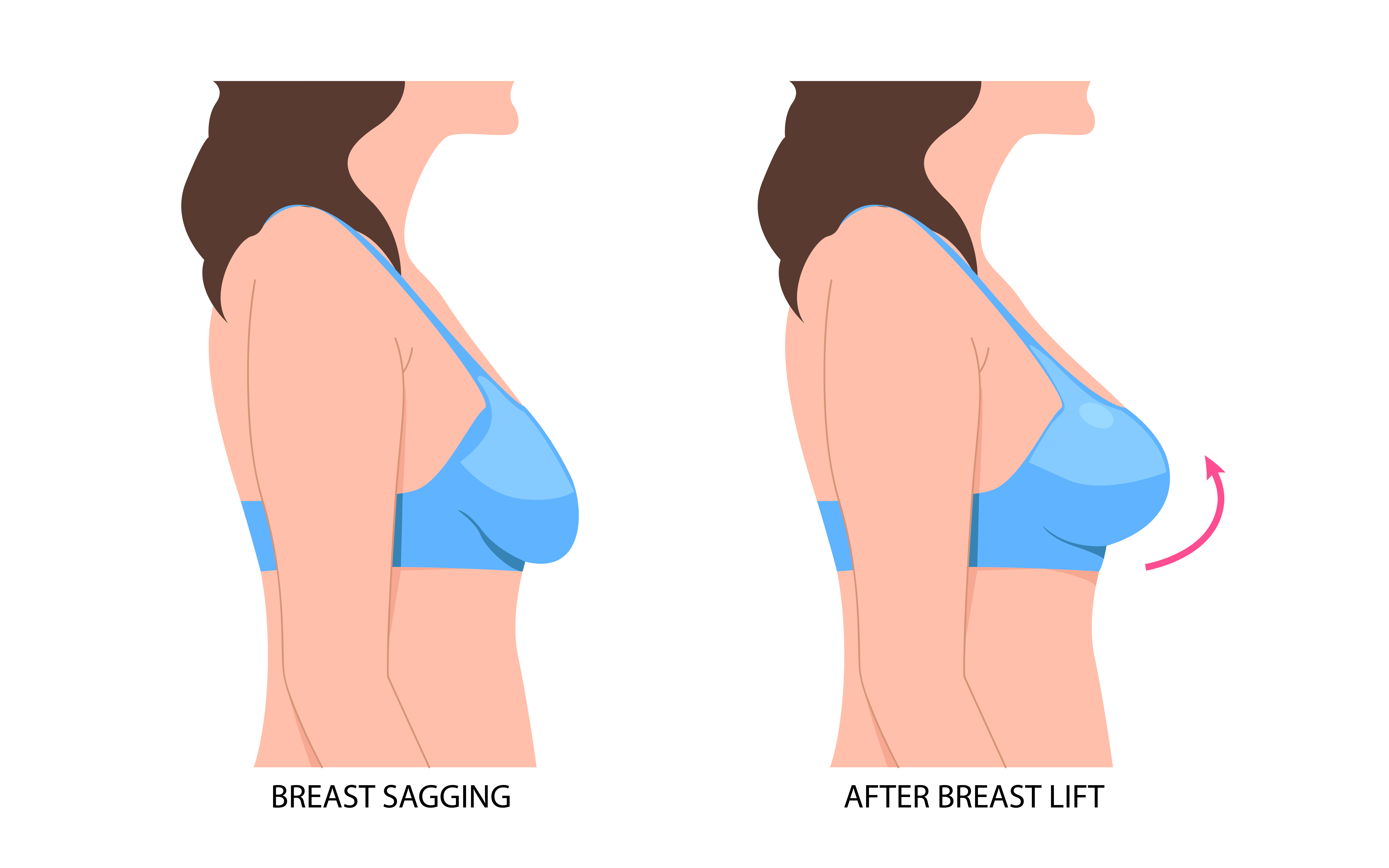 42784428_breast_fat_transfer_lift_asymmetrical_nipple_sag_rejuvenate_surgery_implantation_small_size_droop.jpg