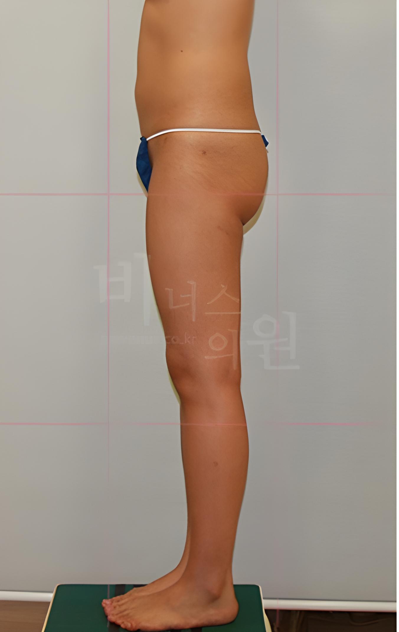 엉덩이축소 지방흡입 수술 전 측면 비너스의원