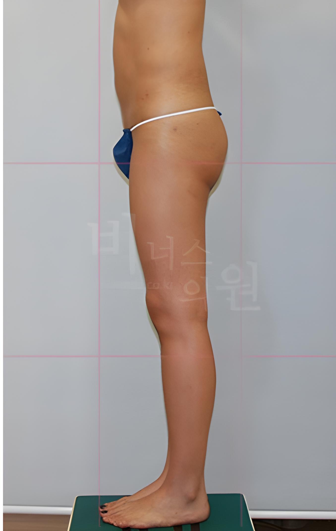엉덩이축소 지방흡입 수술 후 측면 비너스의원