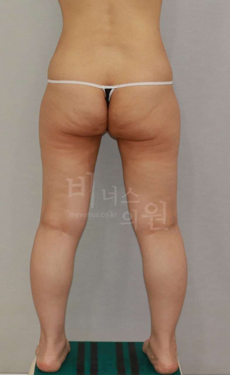 엉덩이 지방흡입 전후사진 후면 수술전 비너스의원