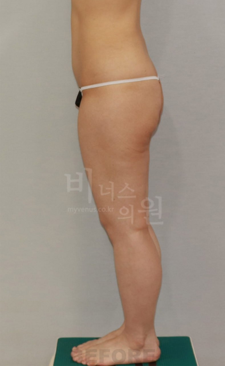 엉덩이 지방흡입 전후사진 측면 수술전 비너스의원