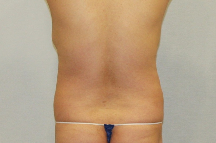 복부등지방흡입_당일 .JPG