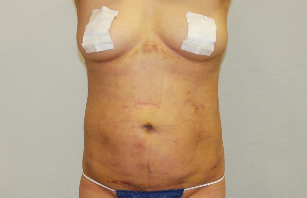 복부축소술.JPG