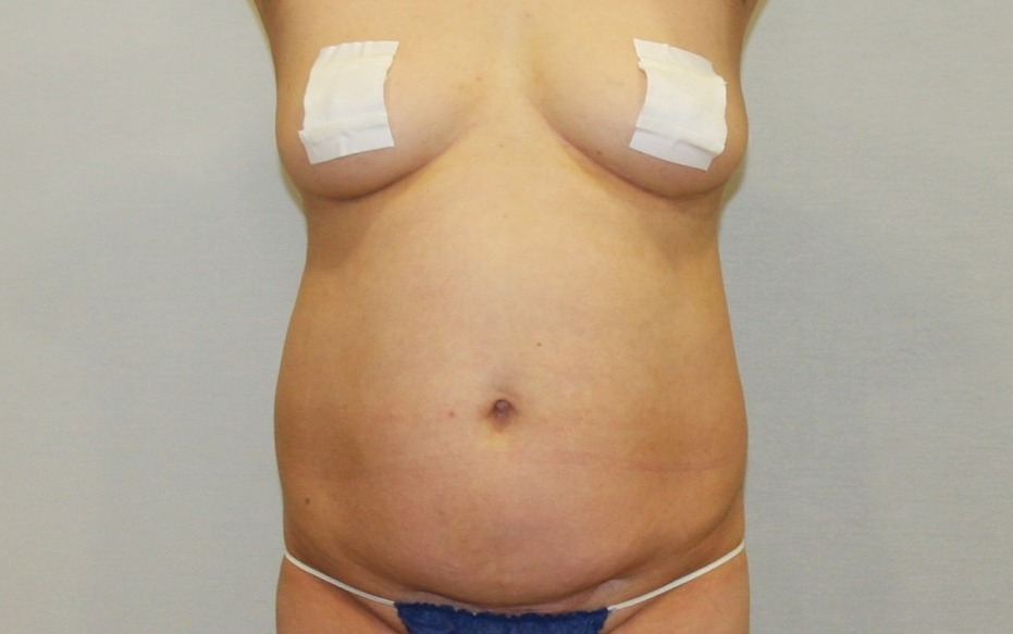 복부 지방흡입 .JPG