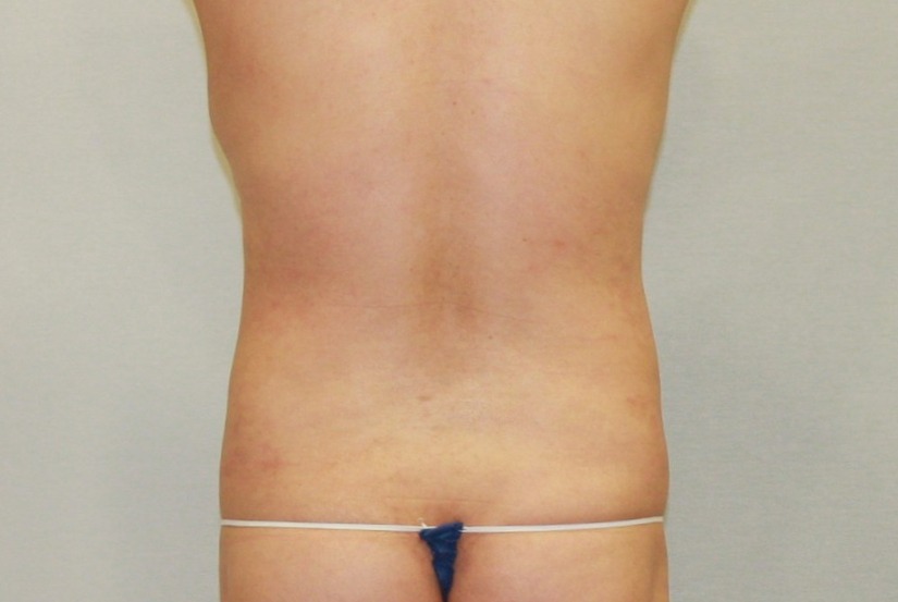 복부등지방흡입 한달.JPG