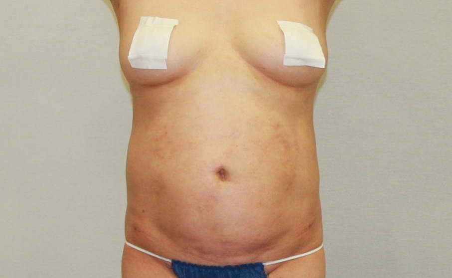 뱃살지방흡입.JPG