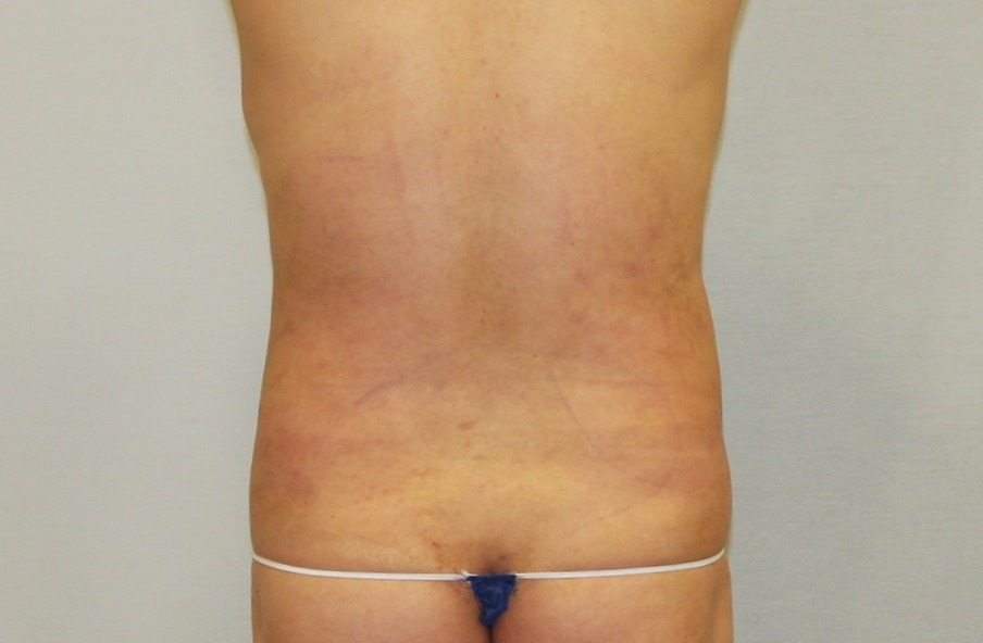 복부 등 지방흡입 1주일.JPG