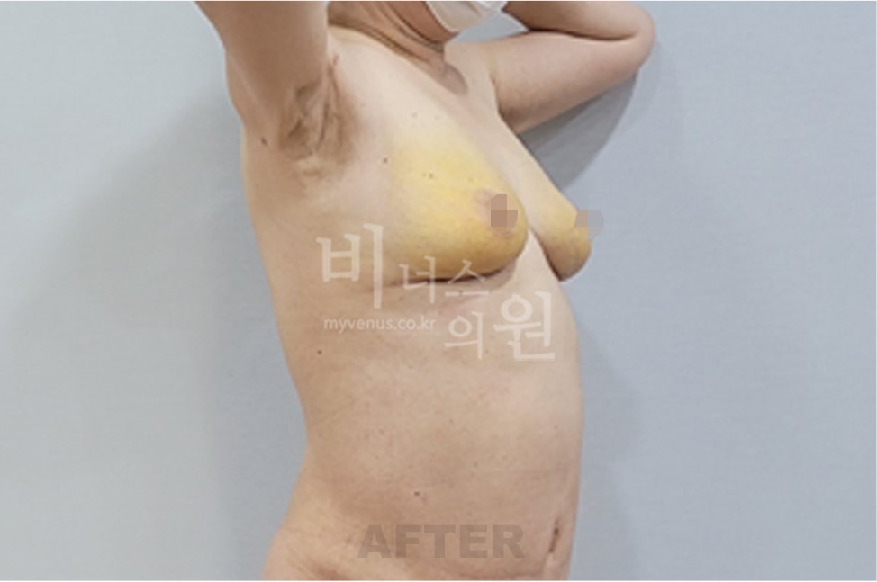 유방하수 표층 지방흡입 수술 후 측면 팔 올린 자세 비너스의원 전후사진