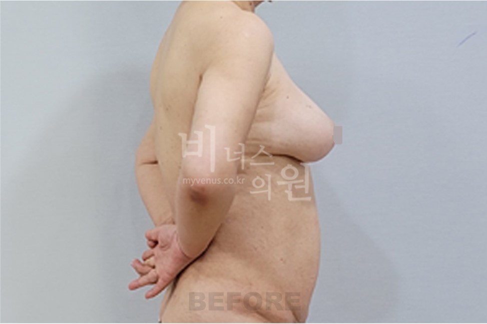 유방하수 표층 지방흡입 수술 전 측면 비너스의원 전후사진