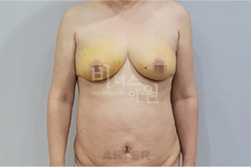 유방하수 표층 지방흡입 수술 후 정면 비너스의원 전후사진