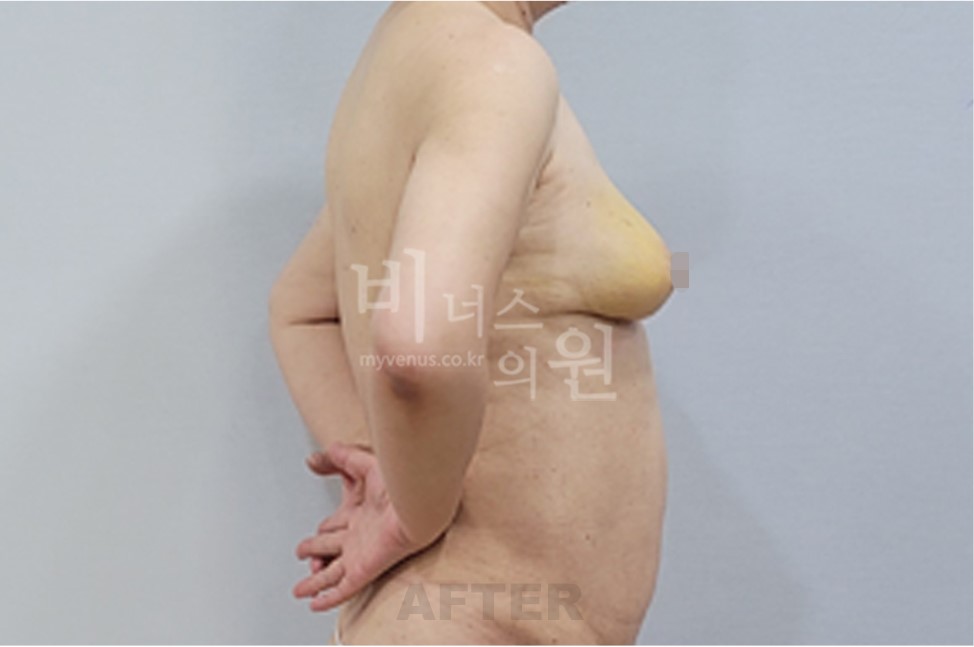 유방하수 표층 지방흡입 수술 후 측면 비너스의원 전후사진