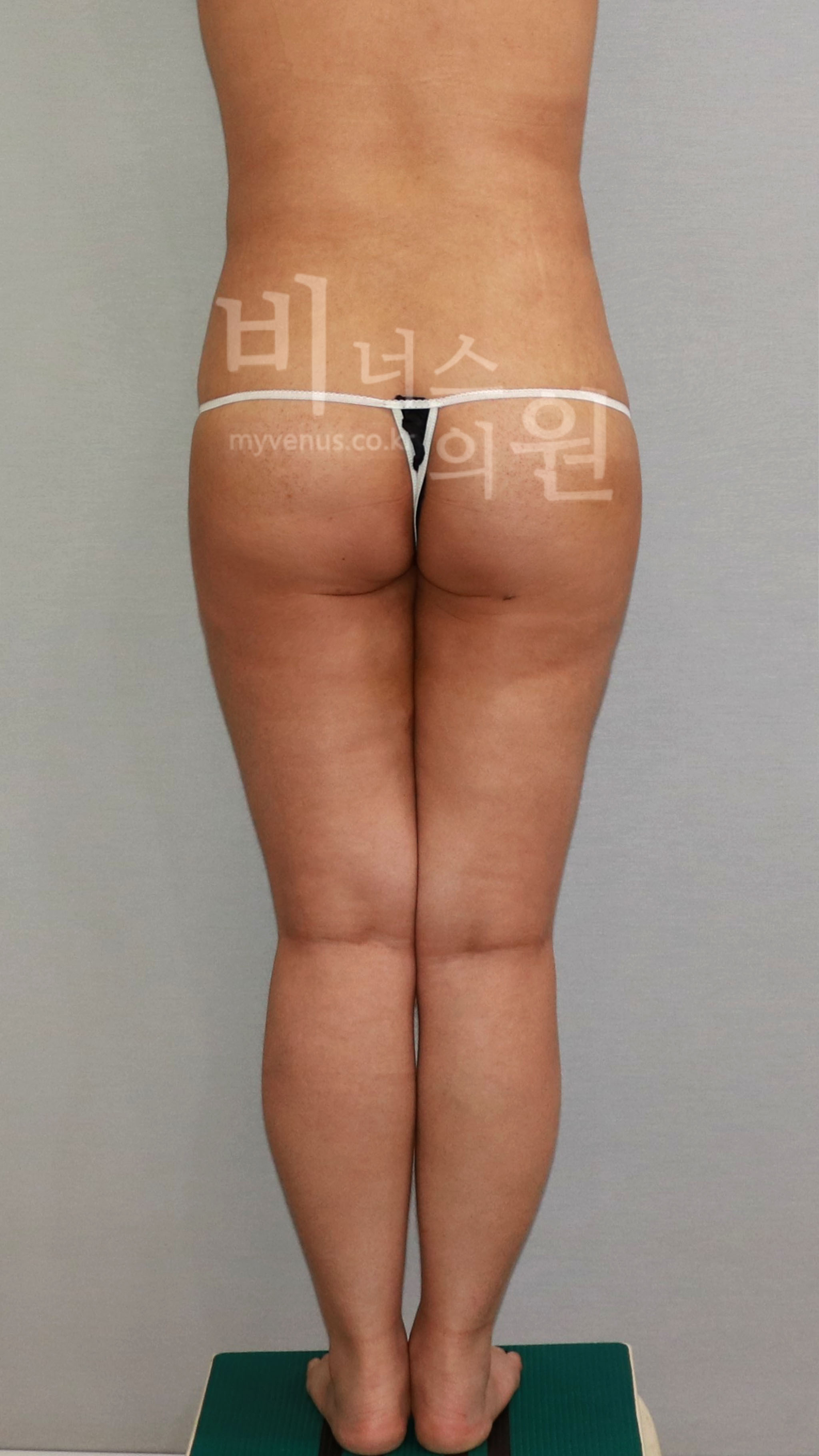 수술 후 — 후면 · 발 모음